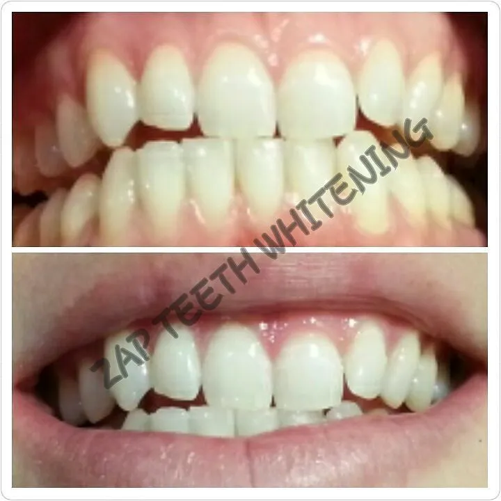 31056 teeth whitening side effects