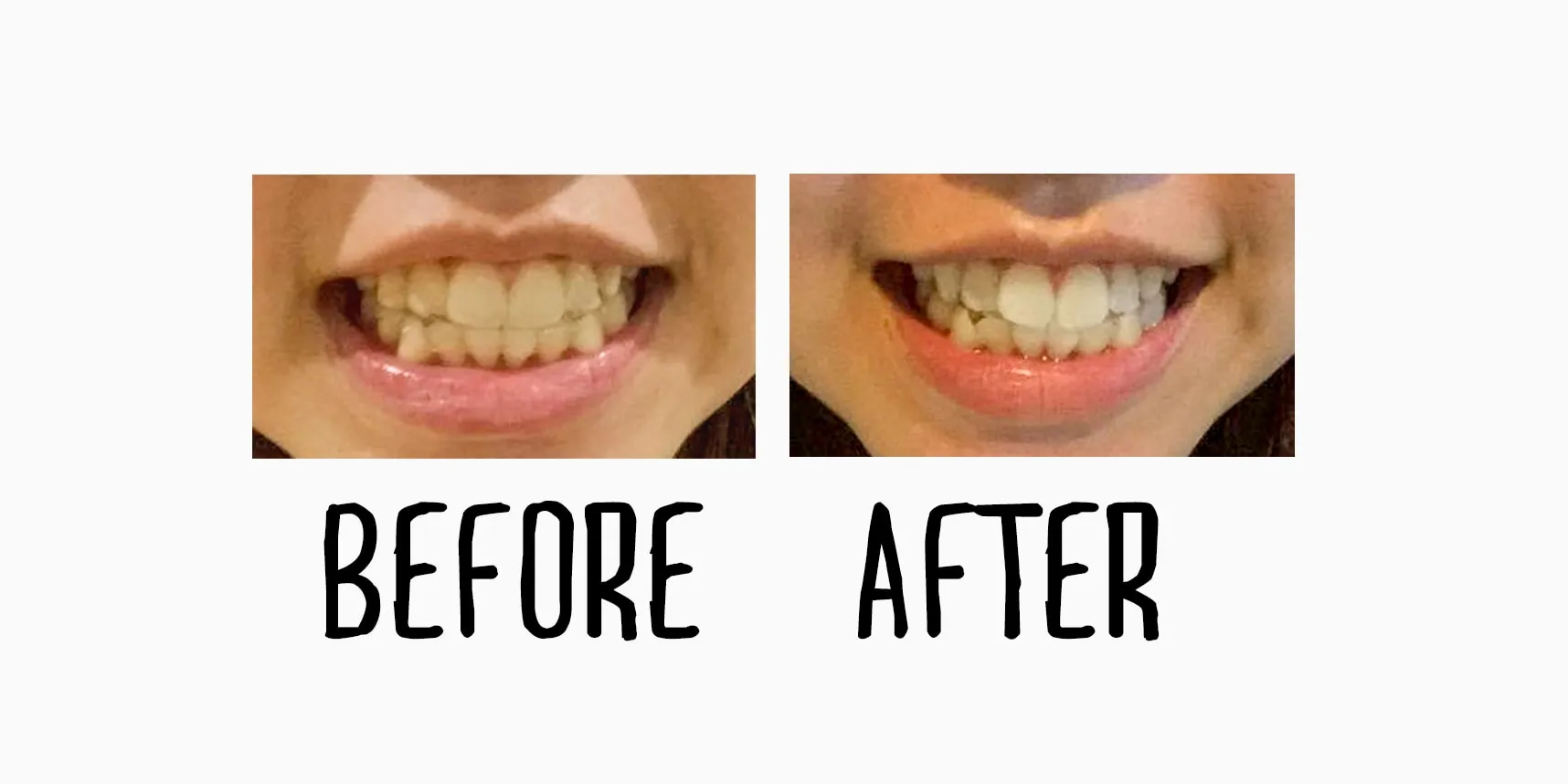 31056 teeth whitening types