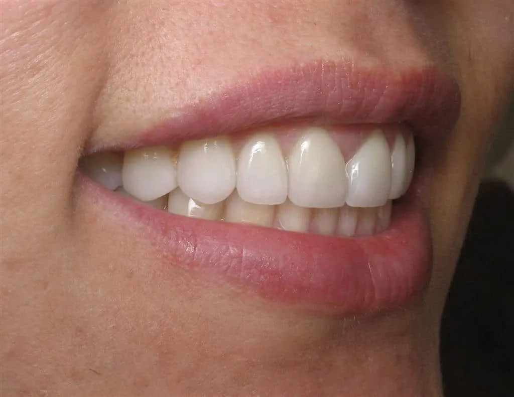 31060 in office teeth whitening