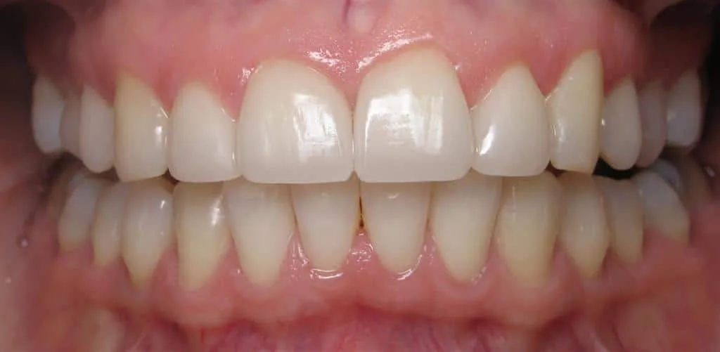 31060 teeth whitening process