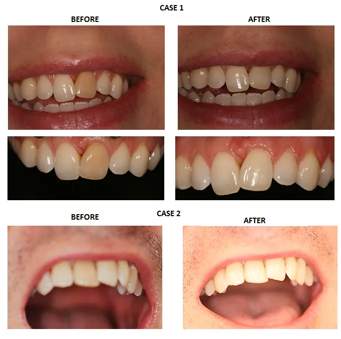 31062 bleaching process