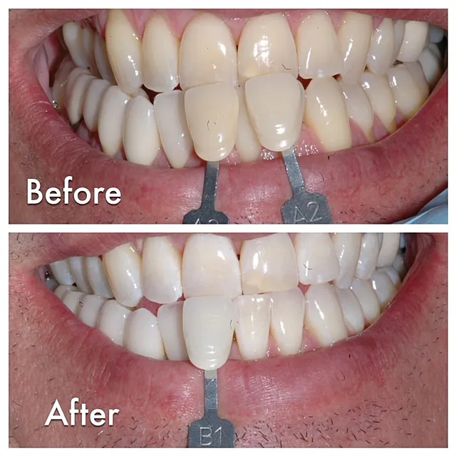 31062 teeth whitening results
