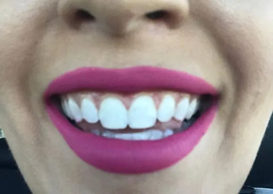 31064 at home whitening