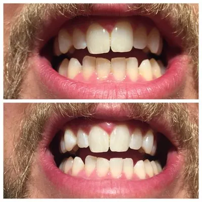 31064 in office whitening