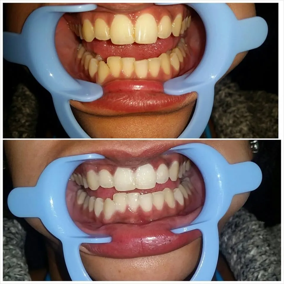 31064 teeth whitening aftercare