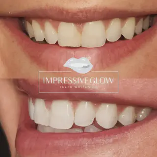 /img/31064-teeth-whitening-results.webp