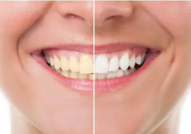 31068 teeth whitening cost