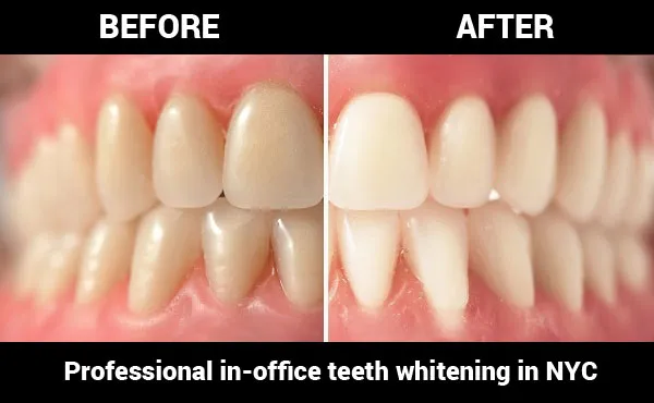 31068 teeth whitening procedure
