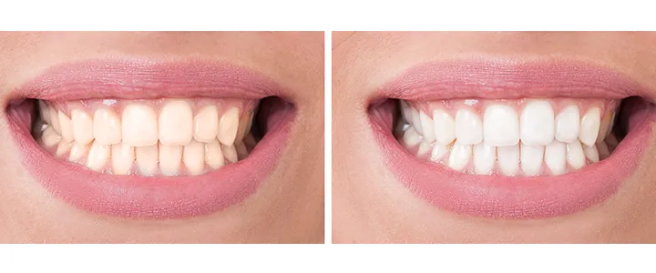 31072 over the counter whitening